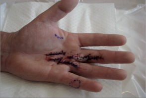Palm of a left hand with Dupuytren's disease