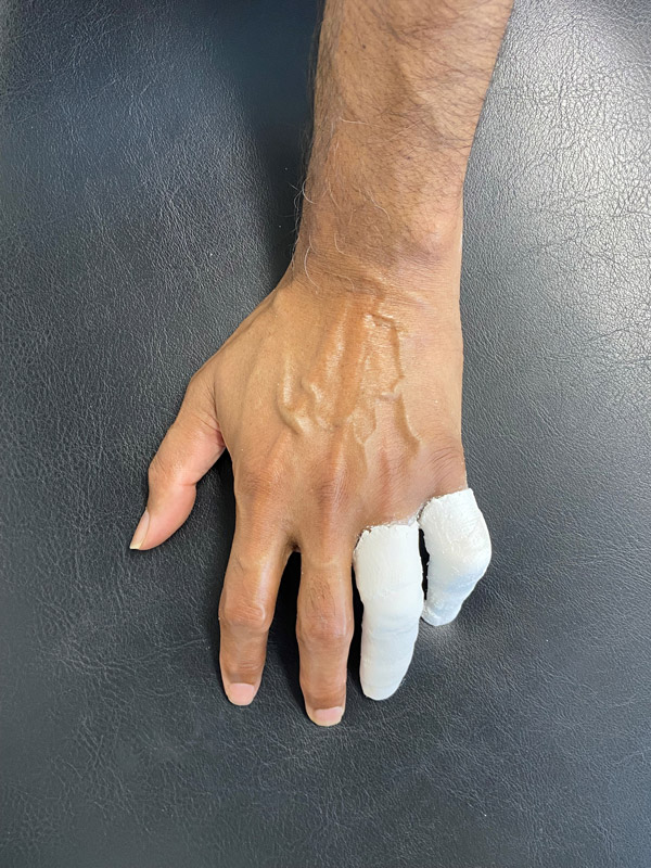 Dupuytren's Disease cast