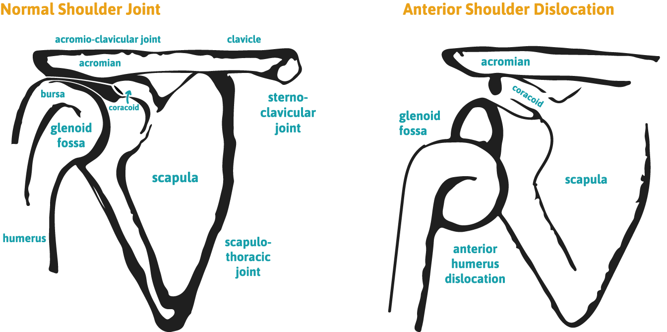 Part Two Instability of the Shoulder Shoulder Dislocation The