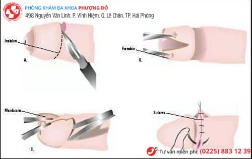 Hình ảnh cắt bao quy đầu xong