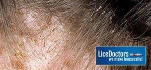 lice sores bites itch scratch pain irritation