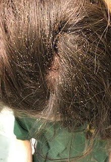 lice tips long term lice infestation bad untreated