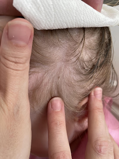 Tucker lice treatment