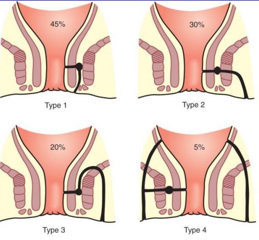 Phân biệt áp xe hậu môn và Rò hậu môn