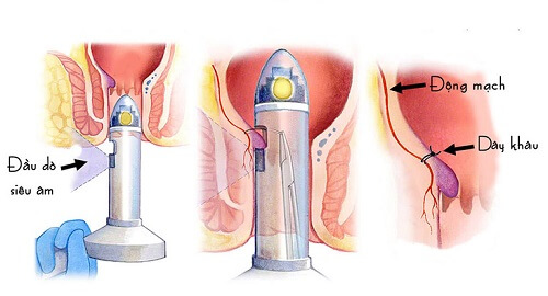 Phẫu thuật trĩ bằng phương pháp siêu âm Doppler – THD