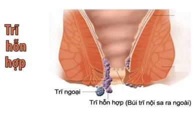 Hình ảnh trĩ hỗn hợp