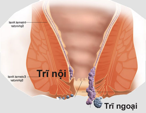 Bệnh trĩ