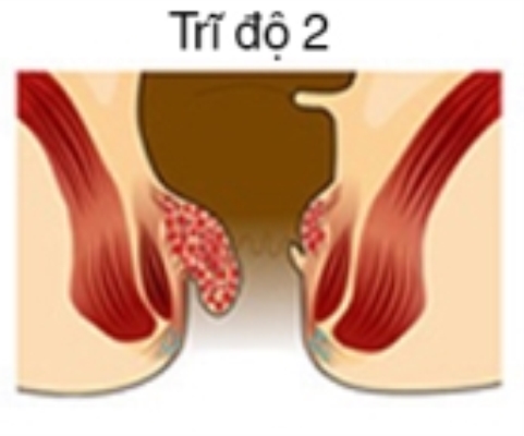 Trĩ nội độ 2