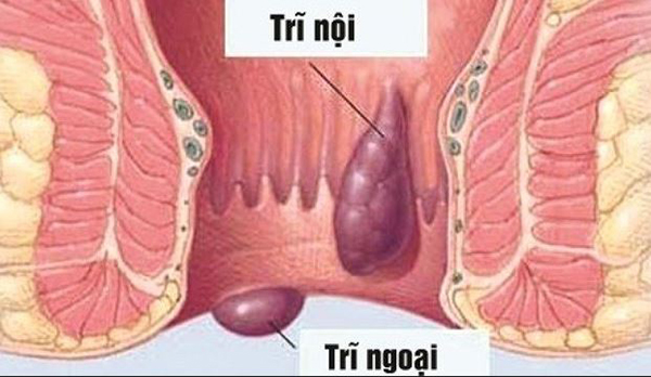 Bệnh trĩ