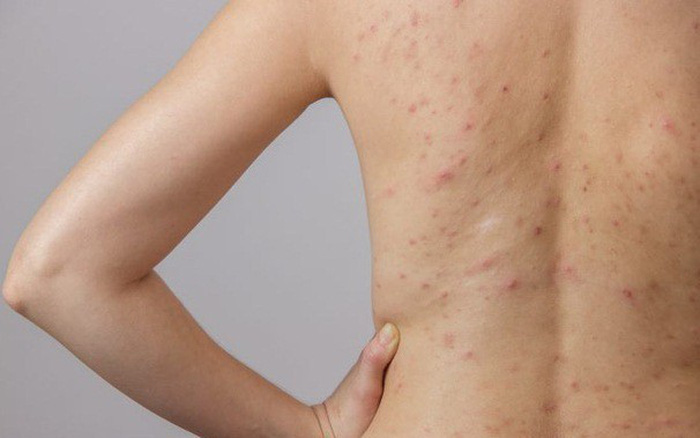 Cô nàng Hàn Quốc trị sạch 100% mụn lưng và vết thâm nhờ "tắm" với sữa rửa mặt, còn gợi ý thêm lọ xịt chuyên dụng chỉ tầm 300k mà trị sạch mọi dấu vết trên lưng - Ảnh 1.