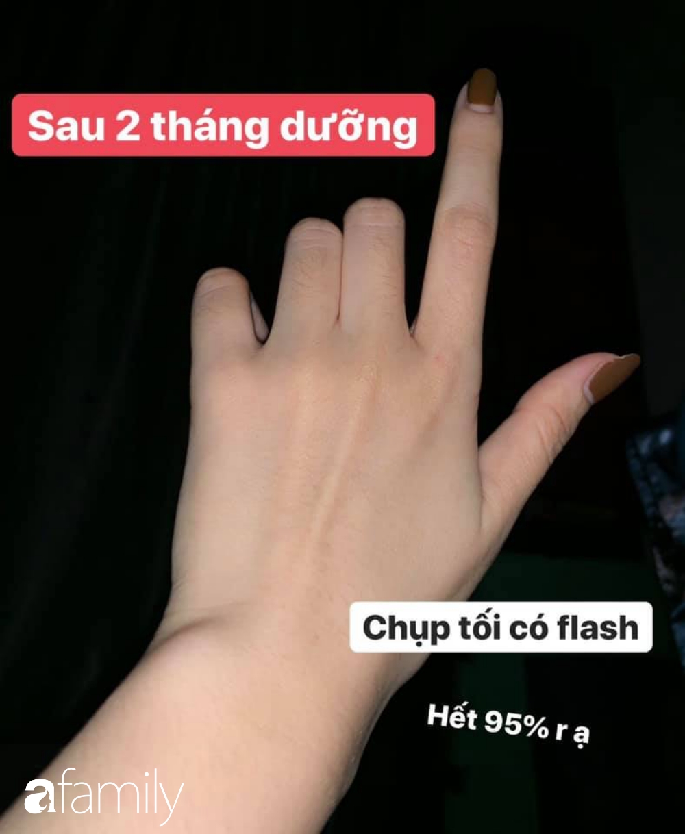 Tự chữa khỏi 95% đốm nâu ở tay, cô nàng này bày sẵn 4 kinh nghiệm và 2 tuýp kem bôi để các chị em học theo - Ảnh 3.