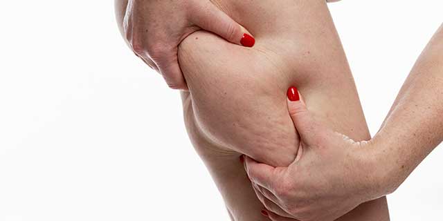 Cellulite