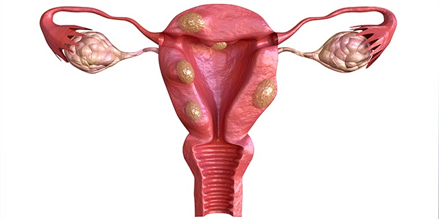 endometriosis symptoms