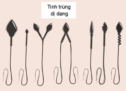 Thế nào là tinh trùng dị dạng?
