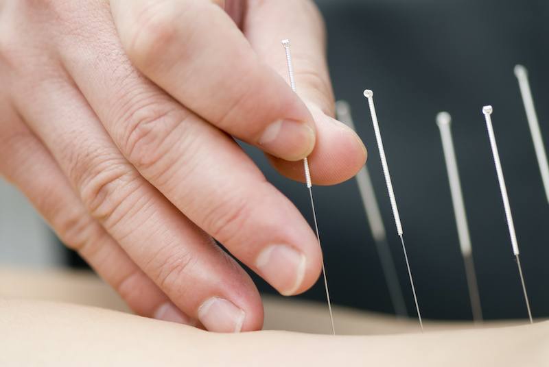 hand putting dry needling acupuncture needs into skin