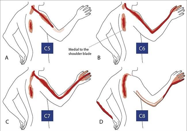 diagram of neck pain causing different patterns of arm shoulder and arm pain