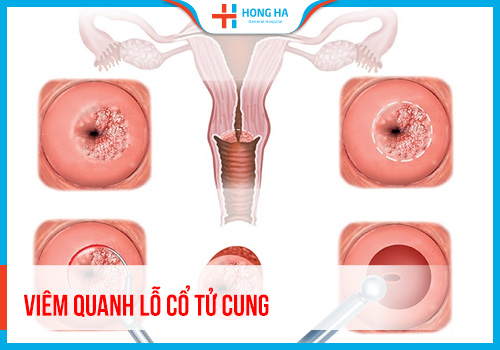 Viêm quanh lỗ cổ tử cung là gì