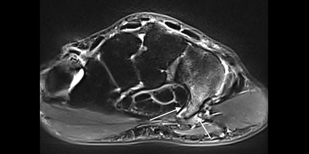 Radiology Review Hook of hamate fracture an unusual cause of hand