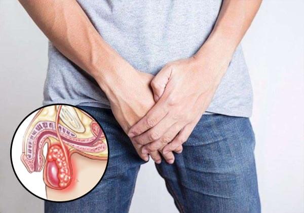 viêm tinh hoàn là bệnh gì?