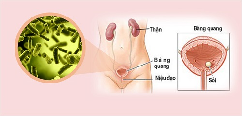 Nhiễm trùng đường tiết niệu