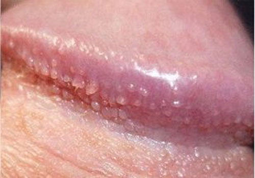 hạt ngọc dương vật là gì