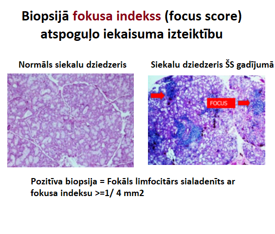 šegrēna sindroms - siekalu dziedzera biopsija