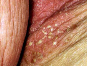 Nhiễm nấm Candida