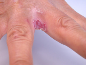 Nhiễm nấm Candida