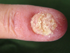 Nhiễm nấm móng