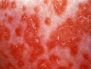 Nhiễm nấm Candida