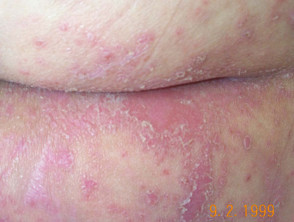 Nhiễm nấm Candida