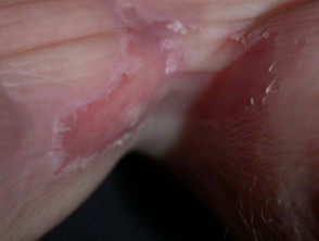Candida intertrigo