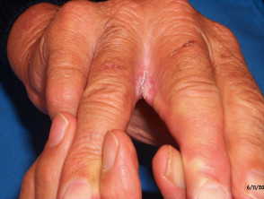 Candida intertrigo
