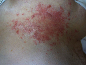 Candida intertrigo