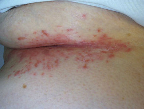Candida intertrigo