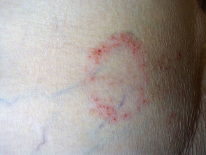Candida intertrigo