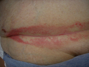 Candida intertrigo