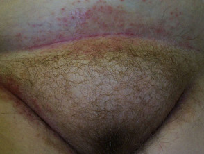 Candida intertrigo