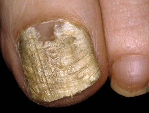 Candida albicans ảnh hưởng đến móng