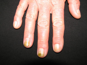 Candida albicans ảnh hưởng đến móng tay