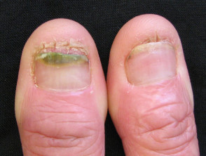 Candida albicans ảnh hưởng đến móng tay