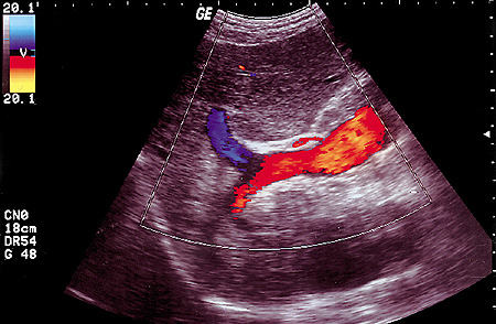 USG de fígado com Doppler, mostrando presença de fluxo hepatofugal (fluxo retrógrado)