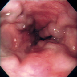 Achado de varizes esofágicas na endoscopia digestiva alta