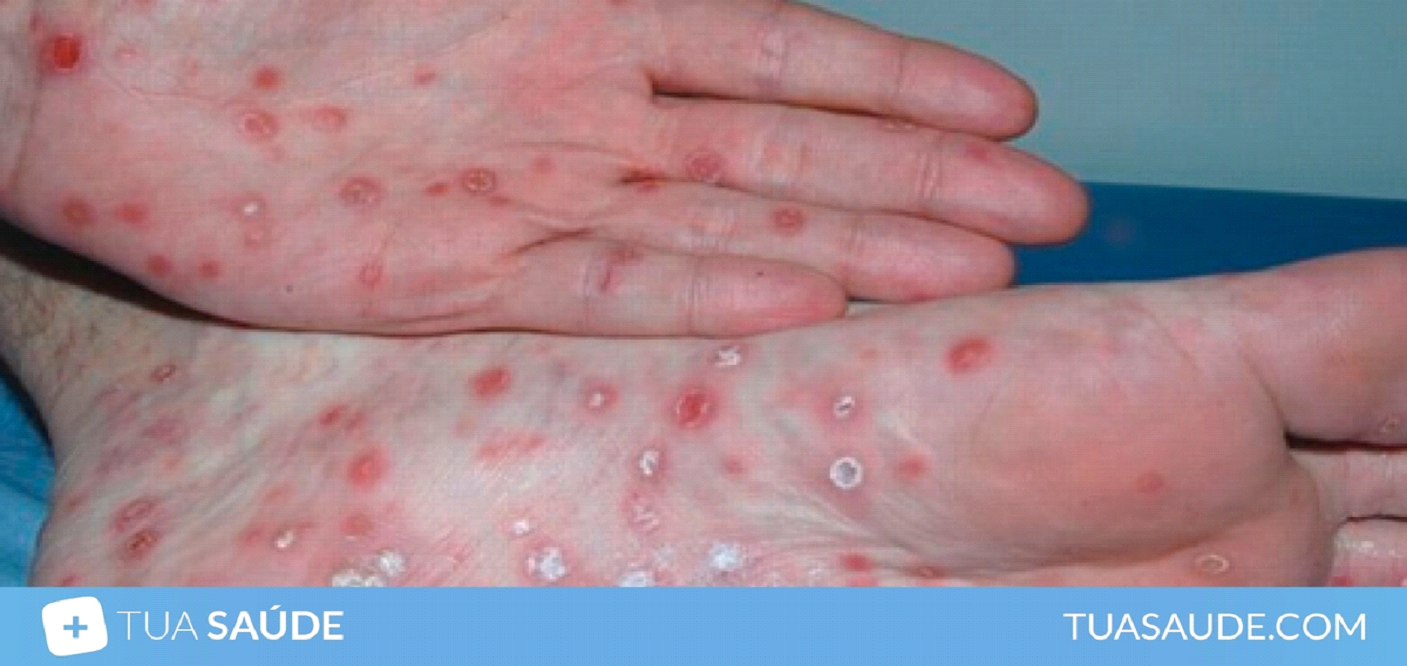 O local mais comum de aparecimento da lesão na sífilis secundária é nas regiões plantar e palmar. Tem características macular ou papular, são simétricas, difusas, localizados no tronco e nas extremidades