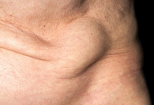 Ao pedir para o seu paciente realizar a manobra de Valsalva, esse foi o achado. Fonte: www.webmd.com