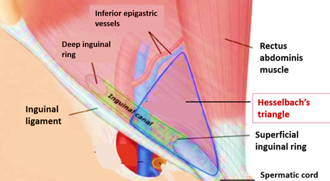 Representação do triângulo de Hasselbach. Quem compõe a base do triângulo são os vasos epigástricos inferiores, os limites laterais são o ligamento inguinal e a borda lateral do músculo reto do abdome e o ápice é formado pelo tubérculo púbico. Fonte: http://cadernomedicina.blogspot.com/2018/08/
