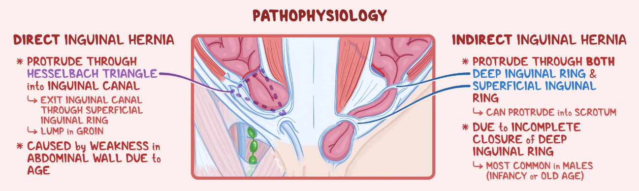 Imagem representativa de como surgem as hérnias inguinais direta e indireta. Perceba que na hérnia inguinal direta, há protusão da víscera através do triângulo de Hasselbach. Já na hérnia inguinal indireta, há a passagem da víscera. através anéis interno e externo do canal inguinal. Fonte:https://www.osmosis.org/answers/Hesselbach-triangle