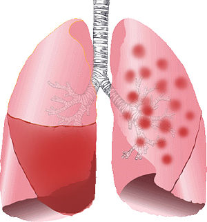 Figura 1: O pulmão esquerdo representa o padrão da pneumonia lobar. Nesse caso, a consolidação causada pela secreção produzida no parênquima pulmonar fica restrito a um lobo. O pulmão direito representa o padrão da broncopneumonia lobular. Nesse caso, a consolidação é irregular. Frequentemente, esse padrão é multilobular e bilateral. Fonte: Wikipédia