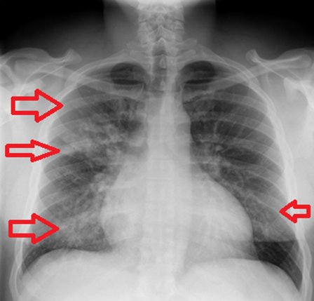 Figura 2: observe as consolidações difusas, assimétricas e bilaterais nesse paciente. Esse achado no Raio-X caracteriza a broncopneumonia lobular. Fonte: Radiopaedia