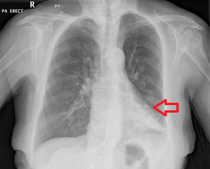 Figura 3: Observe a presença de uma consolidação bem delimitada no lobo inferior esquerdo desse paciente, caracterizando uma pneumonia lobar. A causa mais comum para a pneumonia lobar é a infecção pelo pneumococo. Observe também que houve perda da silhueta cardíaca. Quando a pneumonia lobar acomete o lobo inferior esquerdo do pulmão, as densidades do coração e do lobo pulmonar ficam muito parecidas, fazendo com que seja difícil delimitar ambas as estruturas. Esse achado caracteriza o “sinal da silhueta”. Fonte: Radiopaedia